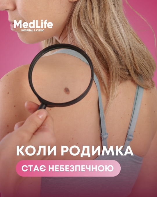 Коли родимка стає небезпечною